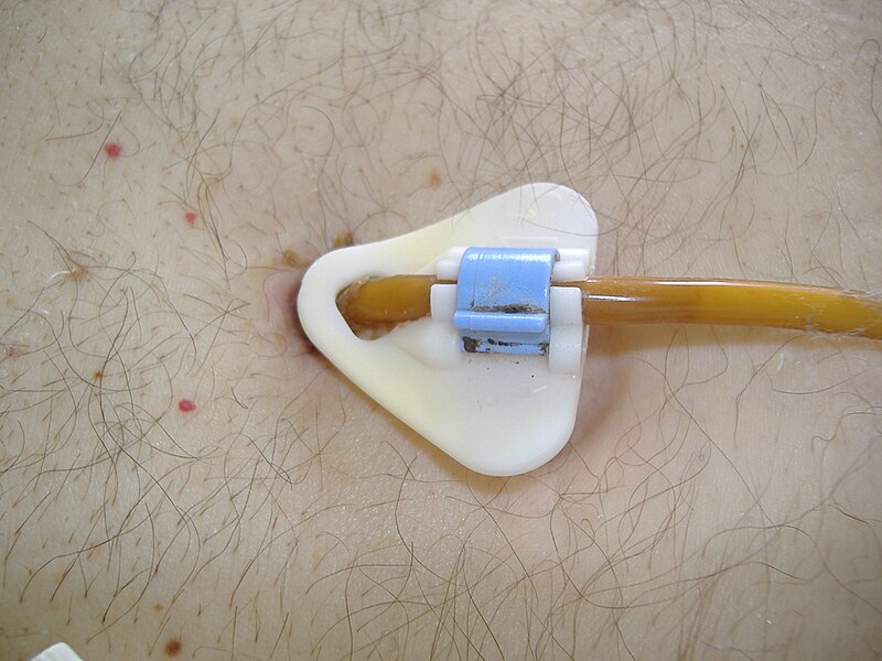 File:Percutaneous endoscopic gastrostomy-tube.jpg