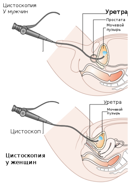 File:Diagram showing a cystoscopy for a man and a woman CRUK 064 ru.svg