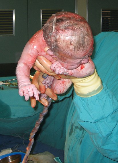 File:Caesarian shown cropped.jpg