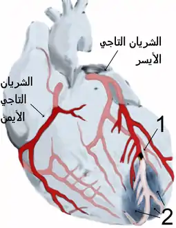 الشريانان التاجيان الأيمن والأيسر يغذيان عضلة القلب نفسها كي يعمل القلب. رسم يبيّن إحتشاء عضلة القلب، وعدم وصول الدم لجزء من عضلة القلب خلال الشريان التاجي الأيسر، بينما الشريان التاجي الأيمن مبين بصورة سليمة في الرسم أعلاه:
المنطقة (1) فيها انسداد موضّح باللون الأسود داخل فرع من الشريان التاجي الأيسر الذي يُغذي الجزء السفلي من عضلة القلب.
المنطقة (2) هي الجدار الأمامي لعضلة القلب، والذي لا يصله الدم بعد الإنسداد الحاصل في المنطقة (1)، ويُمكن رؤية الشريان من بعد الإنسداد وقد تغير لونه لنقص كمية الدم المارّ به، وكذلك لون المنطقة أسفل القلب المتأثرة بانسداد الشريان متغير نتيجة نقص التروية الدموية وبالتالي نقص إمداد الأكسجين.