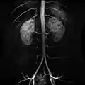 Contrast enhanced MRA of the abdominal aorta demonstrating normal paired arteries.