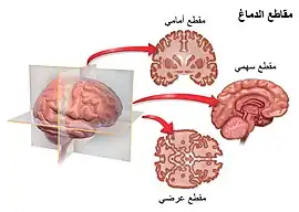 مستوى مقعطي للدماغ.