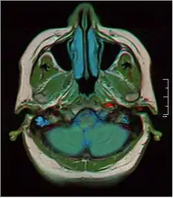 MRI showing fluid in mastoid air cells