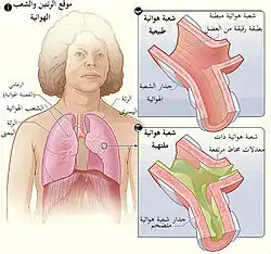 الشكل التوضيحي "أ" يظهر موقع الرئتين والقصبات الهوائية. الشكل التوضيحي "ب" هو صورة مكبرة للقصبات الهوائية السليمة. الشكل التوضيحي "ج" هو صورة مكبرة للقصبا الهوائية الملتهبة.