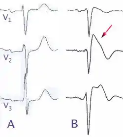 A) تخطيط طبيعي لكهربائية القلب
B) متغيرات تخطيط كهربائية القلب في متلازمة بروغادا