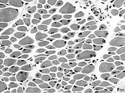 Muscle biopsy from the quadriceps taken at 3 months of age from a girl with X-linked centronuclear ("myotubular") myopathy due to a mutation in the myotubularin (MTM1) gene and extremely skewed X-inactivation (صبغة الهيماتوكسيلين واليوزين, transverse section). Note marked variability in fibre size, moderate increase in connective tissue and numerous central nuclei.