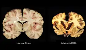 دماغ طبيعي (يسار) ودماغ مصاب ب CTE (يمين)