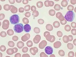 مسحة الدم المحيطي تظهر خلايا CLL