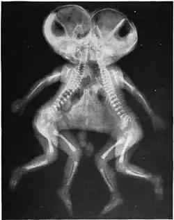 X-ray of joined twins, cephalothoracopagus.