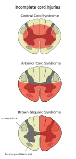 Central cord syndrome is top diagram