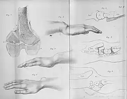 Madelung deformation, a type of bone malformation associated with both SHOX and SHOXY genes mutations.