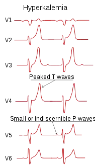 تخطيط كهربائية القلب showing تخطيط كهربائية القلبs in hyperkalemia.