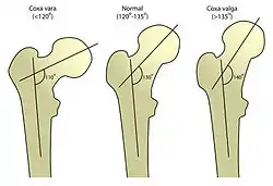 Different femoral abnormalities.