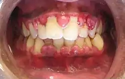 تضخم اللثة can be a feature in some periodontal diseases.