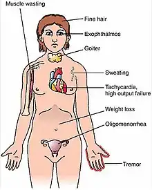 أعراض الدراق الجحوظي أو مرض غريفز (Graves' disease).