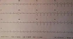 تسرع القلب الوصلي بواسطة تخطيط كهربائية القلب. المركب QRS ضيق. لا توجد P . معدل النبض سريع.