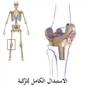 استبدال الركبة.