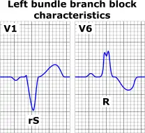 خصائص تخطيط القلب لإحصار الحزيمة اليسرى النموذجي تظهر تجمعات QRS واسعة مع شكل غير طبيعي في ليد V1 وليد V6.