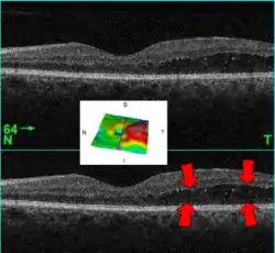 رجل في السادسة والستين من العمر يعاني من مرض السكري من النوع الثاني ,وتمثل هذه الصورة وذمة بقعية,تم تصويرها باستخدام جهاز التصوير الطبقي للتماسك البصري(الأسهم تشيرالى الوذمة).الصورة الموجودة في الوسط عبارة عن تمثيل ثلاثي الأبعاد سمك شبكية العين(الوذمة ملونة باللون الاحمر).).