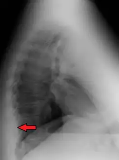 Mediastinal lipomatosis