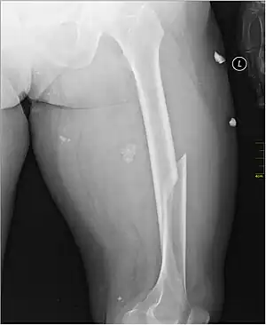 X-ray image of a femoral shaft fracture