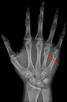 DP (PA) right hand x-ray showing fracture at the neck of العظم السنعي الرابع