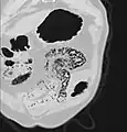 تظهر الصورة الإكليلية MDCT المعاد تنسيقها الاسترواح المعوي المنتشر في الأمعاء الدقيقة الرباعية العلوية اليسرى. يكون الاسترواح المعوي أكثر تكيسًا وعقيديًا في الأمعاء الدقيقة في خط الوسط وعلى يمين خط الوسط. كان لدى هذا المريض عرض حميد نسبيًا بدون نفص تروية معوية وتمت معالجته بشكل تحفظي.