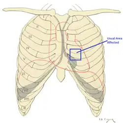 One of the areas more commonly affected in precordial catch syndrome