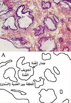 البروستات تحت المجهر الصوة توضح الغدد المجهرية في البروستات