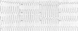 Monomorphic ventricular tachycardia