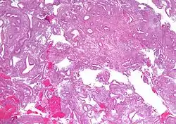 صورة مجهرية showing simple endometrial hyperplasia, where the gland-to-stroma ratio is preserved but the glands have an irregular shape and/or are dilated. خزعة بطانية رحمية. صبغة الهيماتوكسيلين واليوزين.