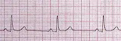 بطء القلب الجيبي الموضّح في الصورة في الاتجاه الثاني ( في تخطيط القلب ) لشخص ينبض قلبه بخمسين نبضة في الدقيقة. 
.