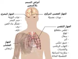 A diagraph showing a man torso and listing symptoms of oxygen toxicity: Eyes – visual field loss, near)sightedness, cataract formation, bleeding, fibrosis; Head – seizures; Muscles – twitching; Respiratory system – jerky breathing, irritation, coughing, pain, shortness of breath, tracheobronchitis, acute respiratory distress syndrome.