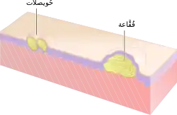 مُخطط يظهر مقطعٌ عرضي من حويصلة (إلى اليسار) وفقاعة (إلى اليمين) على الجلد