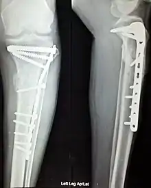 Anterior and lateral view x-rays of fractured left leg with internal fixation