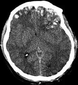 Kompüter tomoqrafiyası müayinəsi: beyin kontuziyası, beyindaxili qansızma,  subdural hematoma, və kəllə sümüyünün sınığı