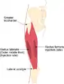 Vastus lateralis-ə əzələdaxili yeridilmə yeri