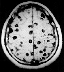 Magnetic resonance image in a person with neurocysticercosis showing many cysts within the brain.