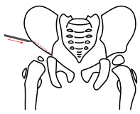 Acetabuloplastik, Schritt 1, Osteotomie des Darmbeins