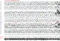 Generalisierter Spike-Wave-Komplex über 20 Sekunden