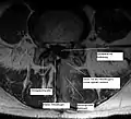 HemilaminektomieBei dieser Operation wurde der gesamte Wirbelbogen auf der betroffenen Seite entfernt. Der Spinalkanal ist nicht mehr gut einsehbar, hier ist Blut eingedrungen