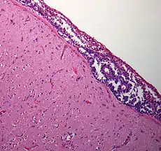 Hirnbiopsie: Nachweis einer Ausbreitung leptomeningealer Tumorzellverbände in einer Hirnbiopsie.Hämatoxylin-Eosin-Färbung.