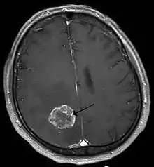 Hirnmetastase eines Bronchialkarzinoms in der Kernspintomographie (T1-Wichtung nach Kontrastmittelgabe)