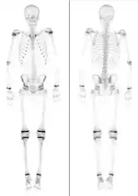 Skelettszintigrafien bei zwei Kindern, links 7 Jahre, rechts 15 Jahre alt (nicht maßstabsgerecht). Jeweils intensiver Knochenstoffwechsel in den Wachstumsfugen.