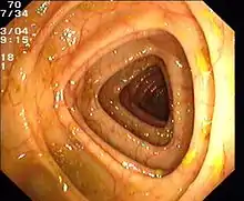 Normaler Dickdarm (Colon transversum)