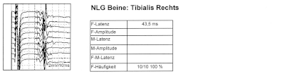 Normale F-Wellen des N. tibialis