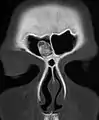 Osteom der Stirnhöhle in der Computertomographie