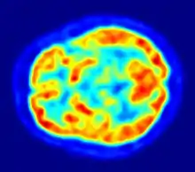 PET-Hirnaufnahme (axiales Schnittbild)