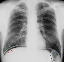 Pneumoperitoneum im Thoraxröntgenbild. Die freie "Luft" ist zwischen dem Oberrand der Leber (rote Pfeile) und dem Zwerchfell (grüne Pfeile) zu erkennen. Die blauen Pfeile zeigen auf den gasgefüllten Dickdarm (normal).