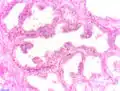 Prostatische intraepitheliale Neoplasie (PIN)